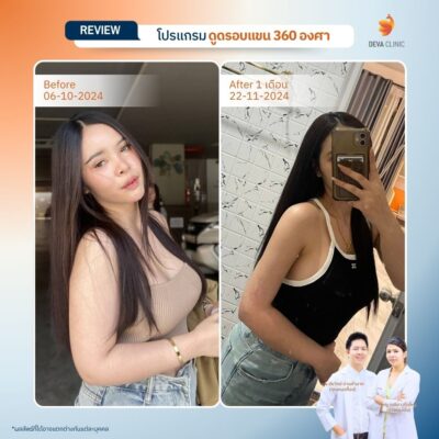 รีวิวต้นแขนหน้าดูดไขมัน 2