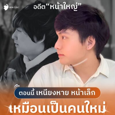 รีวิวดูดไขมันเหรียง คลินิกดูดไขมัน 3