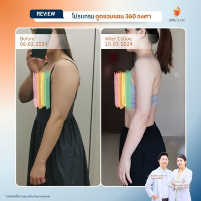 รีวิวต้นแขนหน้าดูดไขมัน 5