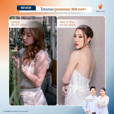 Before & After ต้นแขน 2