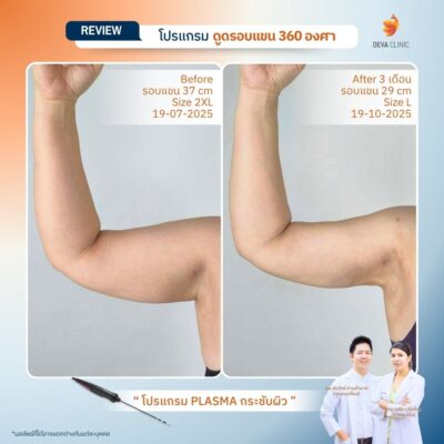 รีวิวแขนย้วย หลังดูดไขมันแขน กระชับผิว jplasma 3