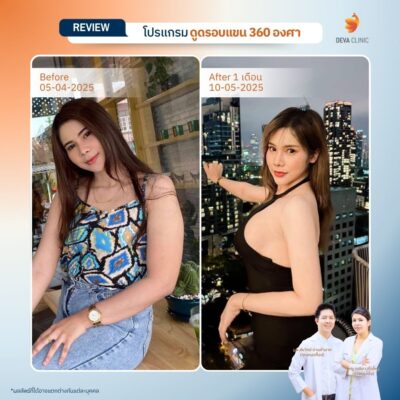 รีวิวต้นแขนหน้าดูดไขมัน 4