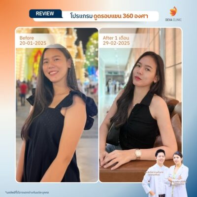 รีวิวต้นแขนหน้าดูดไขมัน 7