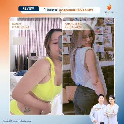 รีวิวต้นแขนหน้าดูดไขมัน 8