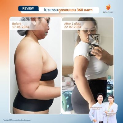 Before & After ต้นแขน 14