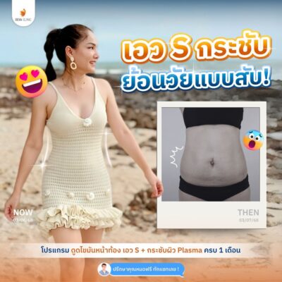 รีวิวดูดไขมันหน้าท้องผู้ใช้จริง 4