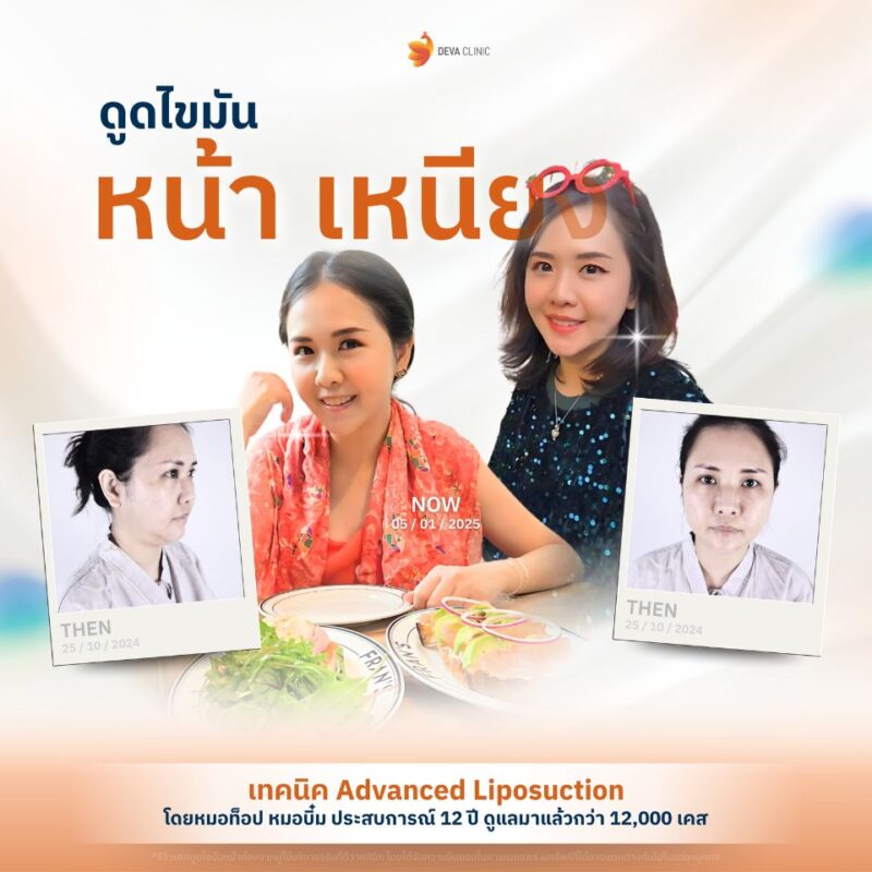 รีวิว deva clinic เคสคุณกล้วยไม้ ดูดไขมันเหนียง