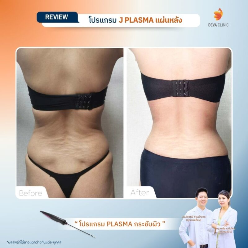 ทำ J plasma ทีหลัง