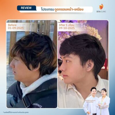 รีวิวหน้าเหนียง หน้าดูดไขมัน 3