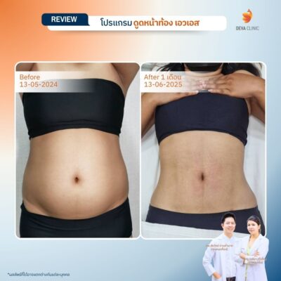 รีวิวทางการแพทย์ท้อง 1