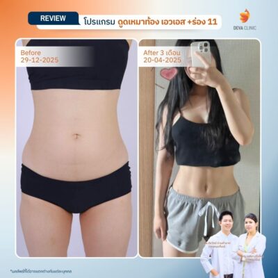 รีวิวดูดไขมันร่อง 11 6