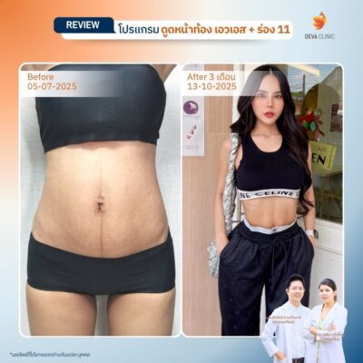 รีวิวดูดไขมันร่อง 11 1