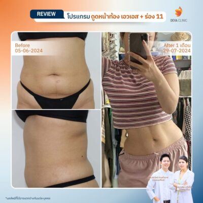 รีวิวดูดไขมันร่อง 11