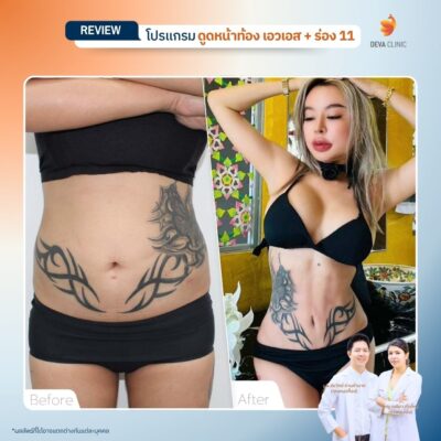 รีวิวดูดไขมันร่อง 11 5