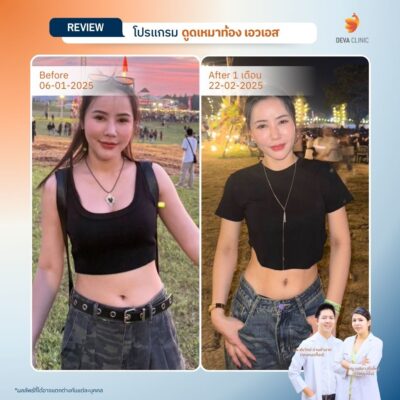 รีวิวดูดไขมันร่อง 11 8