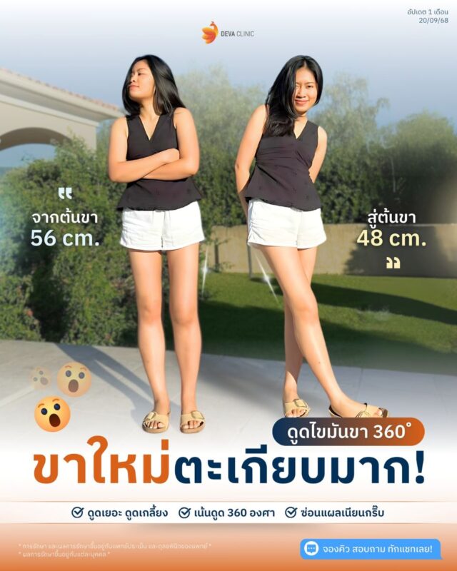 รีวิว deva clinic เคสคุณบีต้า ดูดไขมันต้นขา