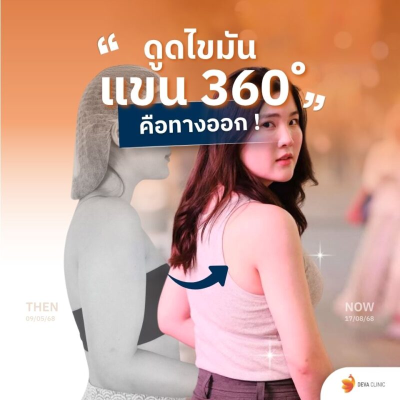 ดูดไขมันต้นแขน คือ ทางออก