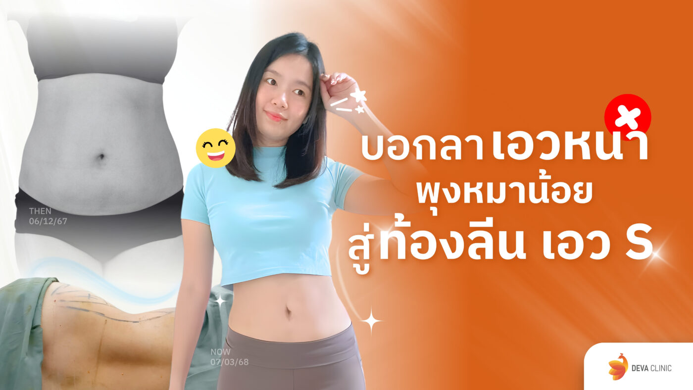 ดูดไขมันหน้าท้อง