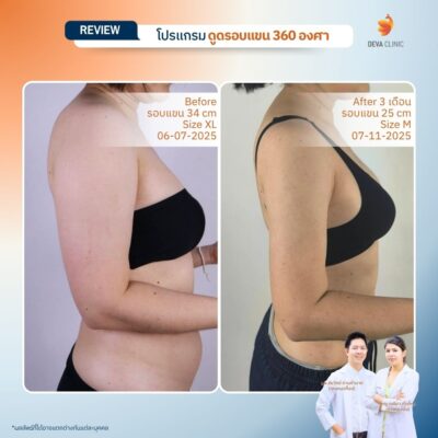 รีวิวต้นแขน คุณ