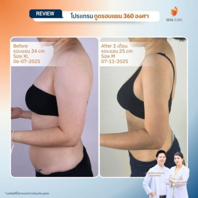 รีวิวดูดไขมันต้นแขน 10