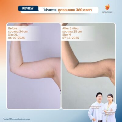 รีวิวดูดไขมันต้นแขน 360 องศา ท้องแขน