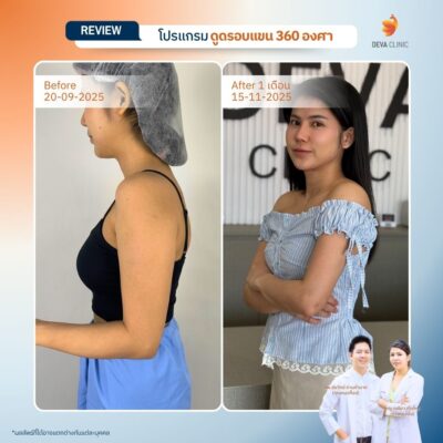 รีวิวดูดไขมันแขน 360 องศา คุณนิ้ง