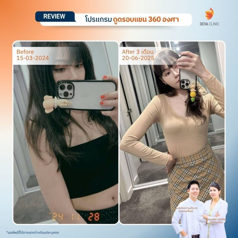 คุณลีน หลังดูดแขน