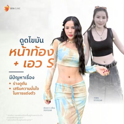 รีวิวหน้าท้อง ศูนย์ดูดไขมัน