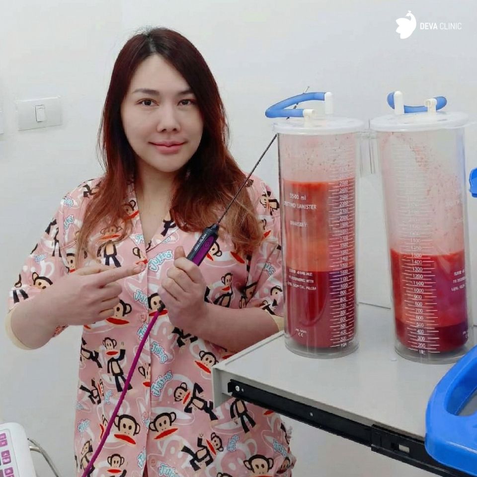 คุณกอล์ฟ ดูดแขนท้อง