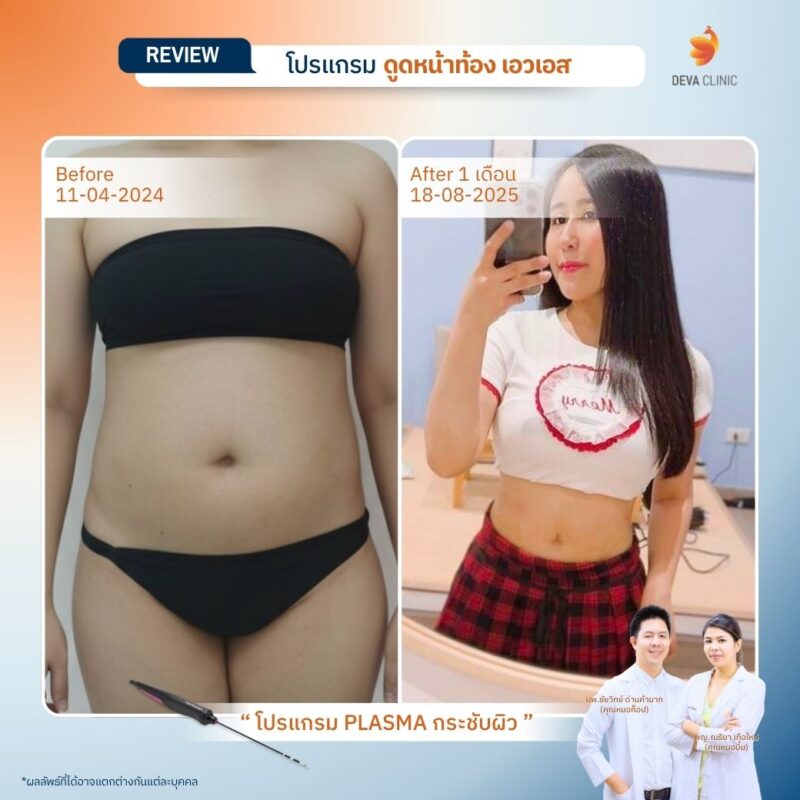 คุณชมพู่ หลังดูดหน้าท้อง