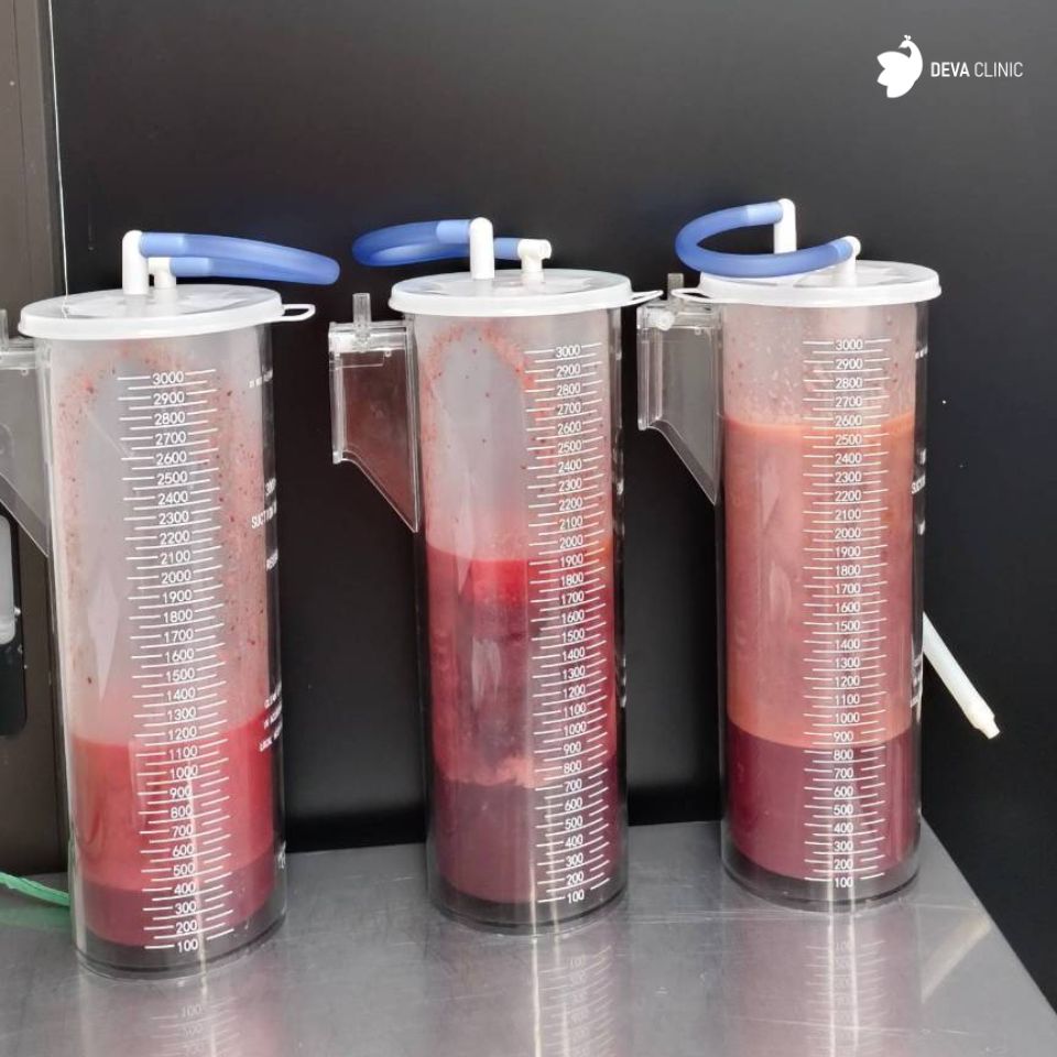 คุณกอล์ฟ ดูดขา