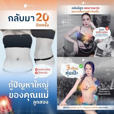 รีวิวดูดไขมัน คุณแม่หลังคลอด