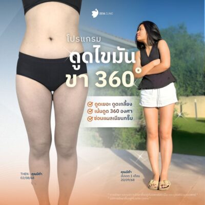 รีวิวดูดไขมันต้นขา คุณบีต้า