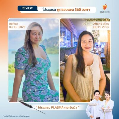 รีวิวต้นแขน คุณภัทร