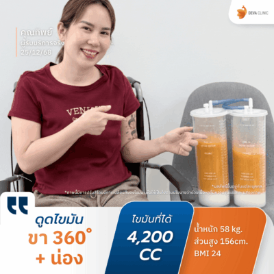 คลินิกดูดไขมัน ตอบโจทย์ด้านผลลัพธ์: ด้วยเทคนิคเน้นดูดเยอะ ดูดเกลี้ยง 1