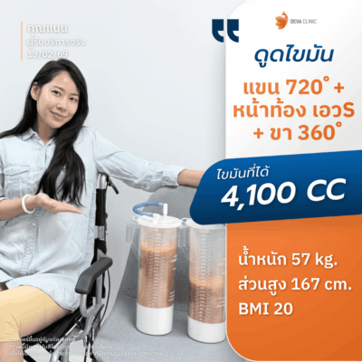คลินิกดูดไขมัน ตอบโจทย์ด้านผลลัพธ์: ด้วยเทคนิคเน้นดูดเยอะ ดูดเกลี้ยง 10