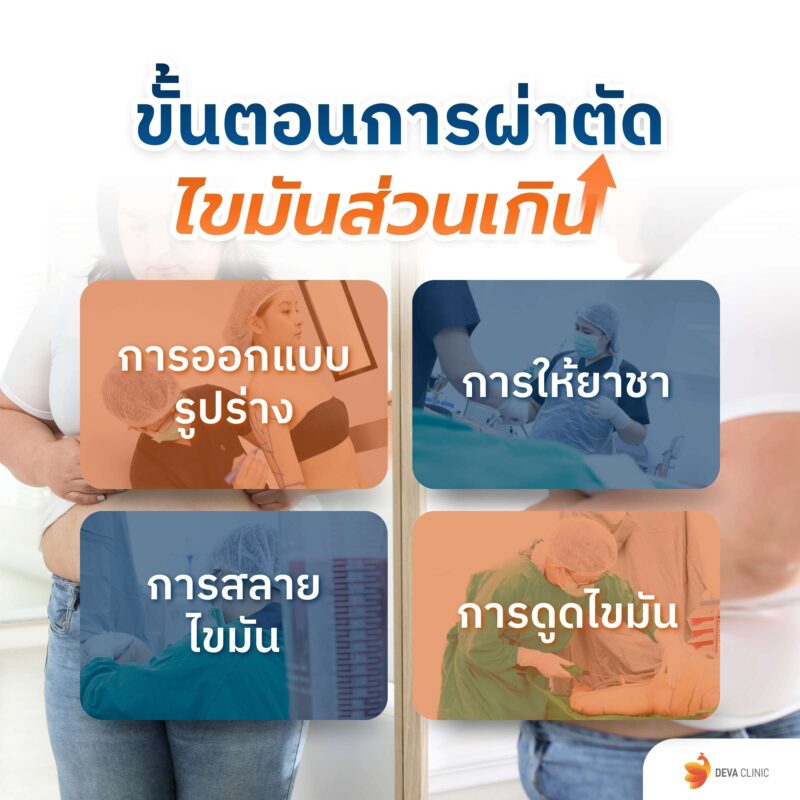 ขั้นตอนการผ่าตัดไขมันส่วนเกิน