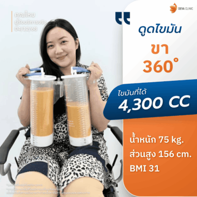 คลินิกดูดไขมัน ตอบโจทย์ด้านผลลัพธ์: ด้วยเทคนิคเน้นดูดเยอะ ดูดเกลี้ยง 5