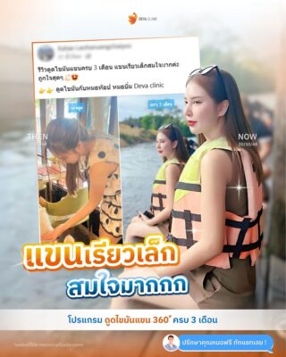 รีวิวหมอดูดไขมันเก่งๆ ต้นแขน 1