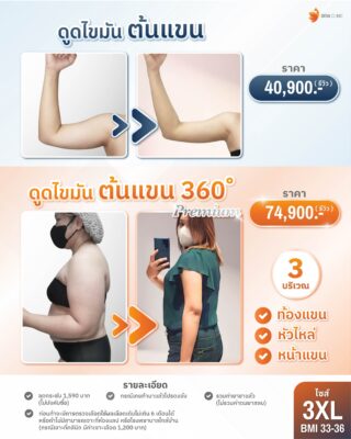 ราคาดูดไขมันต้นแขน 3XL