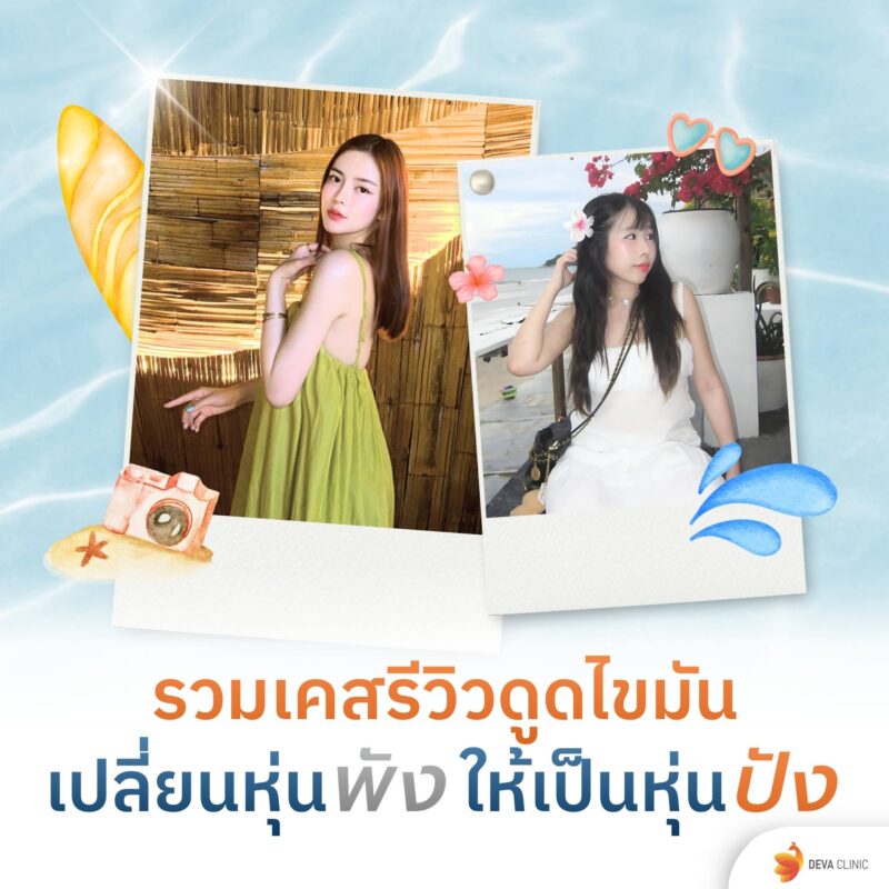 รวมเคสรีวิวดูดไขมัน