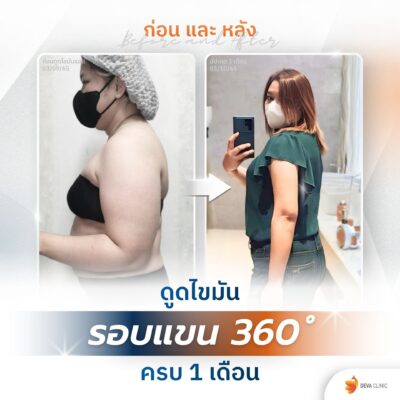 รีวิวแขน 360 องศา คุณโอปอ
