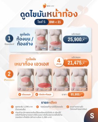 ราคาดูดไขมันหน้าท้อง S