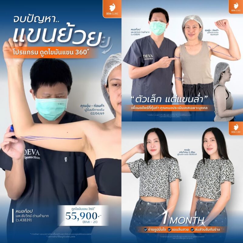 4 บริเวณยอดฮิตในการผ่าตัดไขมันส่วนเกิน ต้นแขน