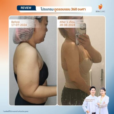 รีวิวดูดไขมันแขน เคสจริงจาก Deva Clinic แขนเรียวกระชับ แผลเล็ก เจ็บน้อย 4