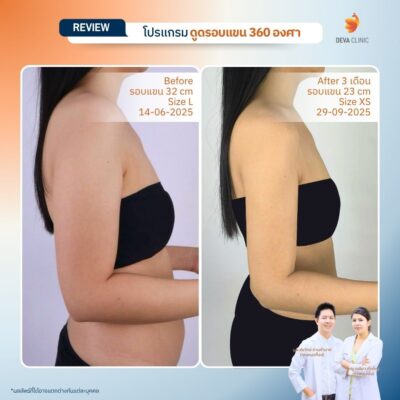 รีวิวดูดไขมันต้นแขนสาวตัวเล็ก แต่แขนใหญ่ (Skinny Fat) 5