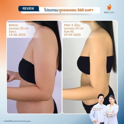 รีวิวดูดไขมันแขน เคสจริงจาก Deva Clinic แขนเรียวกระชับ แผลเล็ก เจ็บน้อย 17