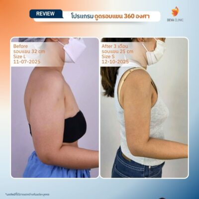 รีวิวดูดไขมันแขน เคสจริงจาก Deva Clinic แขนเรียวกระชับ แผลเล็ก เจ็บน้อย 14