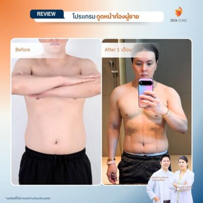 รีวิวดูดไขมันผู้ชาย ปั้นซิกแพค Deva Clinic 1