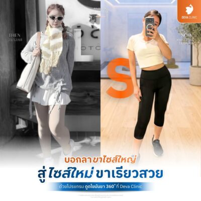 รีวิวต้นขา คุณออมสิน การเตรียมตัวก่อนดูดไขมันมัน